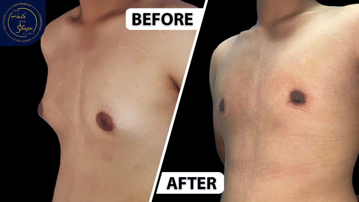 Gynecomastia result8
